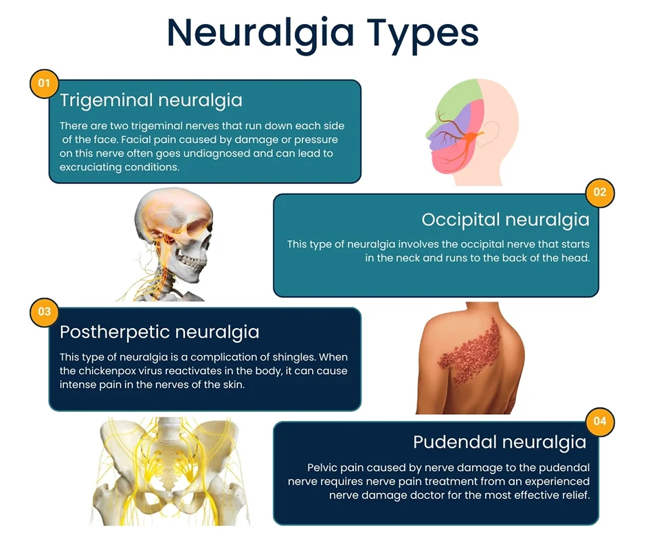 Descubre los diferentes tipos de neuralgias y cómo tratarlas ...